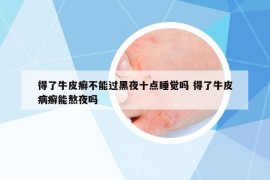 得了牛皮癬不能過黑夜十點睡覺嗎 得了牛皮病癬能熬夜嗎