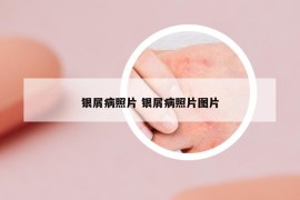 銀屑病照片 銀屑病照片圖片