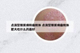 點(diǎn)滴型銀屑病和扁桃體 點(diǎn)滴型銀屑病扁桃體肥大吃什么藥最好