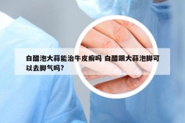 白醋泡大蒜能治牛皮癬嗎 白醋跟大蒜泡腳可以去腳氣嗎?