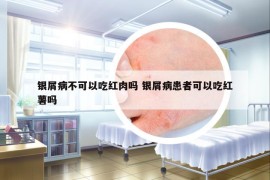 銀屑病不可以吃紅肉嗎 銀屑病患者可以吃紅薯嗎