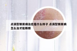 點(diǎn)滴型銀屑病治愈是什么樣子 點(diǎn)滴型銀屑病怎么治才能斷根