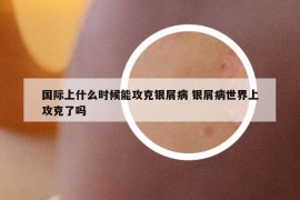 國際上什么時候能攻克銀屑病 銀屑病世界上攻克了嗎