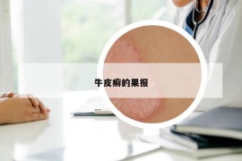 牛皮癬的果報