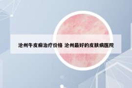 滄州牛皮癬治療價格 滄州最好的皮膚病醫(yī)院