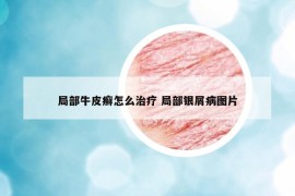 局部牛皮癬怎么治療 局部銀屑病圖片