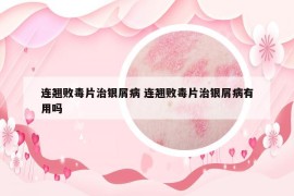 連翹敗毒片治銀屑病 連翹敗毒片治銀屑病有用嗎