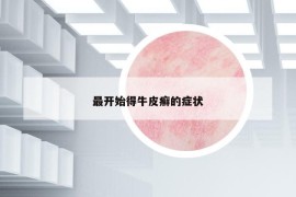 最開始得牛皮癬的癥狀