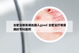 合肥治銀屑病選國人good 合肥治療銀屑病的?？漆t(yī)院