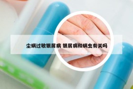 塵螨過敏銀屑病 銀屑病和螨蟲有關(guān)嗎