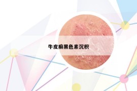牛皮癬黑色素沉積