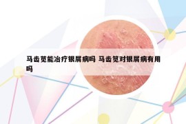 馬齒莧能冶療銀屑病嗎 馬齒筧對銀屑病有用嗎