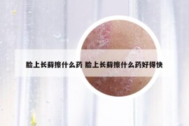 臉上長蘚擦什么藥 臉上長蘚擦什么藥好得快