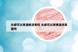 頭癬可以用酒精消毒嗎 頭癬可以用碘酒殺真菌嗎