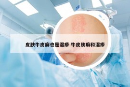 皮膚牛皮癬也是濕疹 牛皮膚癬和濕疹