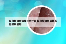 反向性銀屑病要注意什么 反向型銀屑病比其他銀屑病好