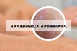 點狀銀屑病會起臉上嗎 點狀銀屑病會傳染嗎
