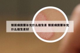 銀屑病需要補(bǔ)充什么維生素 銀屑病需要補(bǔ)充什么維生素好