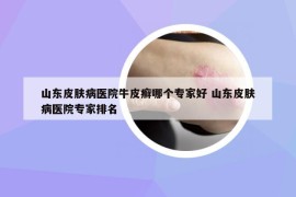 山東皮膚病醫(yī)院牛皮癬哪個(gè)專(zhuān)家好 山東皮膚病醫(yī)院專(zhuān)家排名