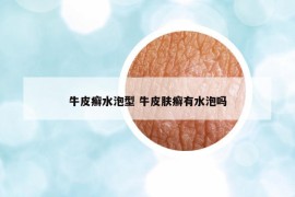 牛皮癬水泡型 牛皮膚癬有水泡嗎