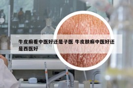 牛皮癬看中醫(yī)好還是子醫(yī) 牛皮膚癬中醫(yī)好還是西醫(yī)好