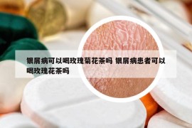 銀屑病可以喝玫瑰菊花茶嗎 銀屑病患者可以喝玫瑰花茶嗎