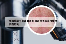 銀屑病關(guān)節(jié)炎注射激素 銀屑病關(guān)節(jié)炎打生物藥劑好處