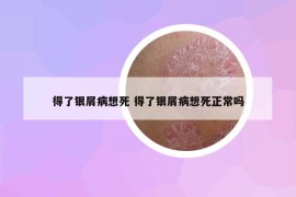 得了銀屑病想死 得了銀屑病想死正常嗎