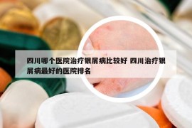 四川哪個(gè)醫(yī)院治療銀屑病比較好 四川治療銀屑病最好的醫(yī)院排名