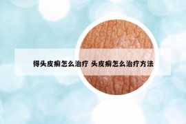得頭皮癬怎么治療 頭皮癬怎么治療方法