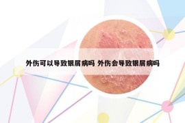 外傷可以導(dǎo)致銀屑病嗎 外傷會(huì)導(dǎo)致銀屑病嗎