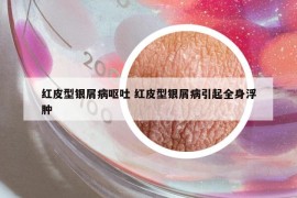 紅皮型銀屑病嘔吐 紅皮型銀屑病引起全身浮腫