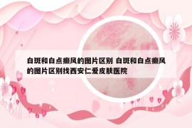 白斑和白點癲風(fēng)的圖片區(qū)別 白斑和白點癲風(fēng)的圖片區(qū)別找西安仁愛皮膚醫(yī)院