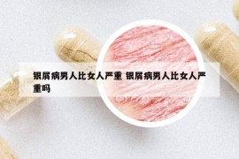 銀屑病男人比女人嚴(yán)重 銀屑病男人比女人嚴(yán)重嗎