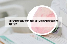 重慶銀屑病科好的醫(yī)院 重慶治療銀屑病醫(yī)院哪個好