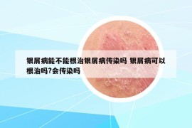 銀屑病能不能根治銀屑病傳染嗎 銀屑病可以根治嗎?會(huì)傳染嗎