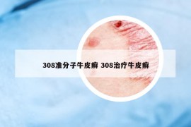 308準(zhǔn)分子牛皮癬 308治療牛皮癬