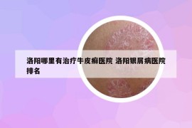 洛陽哪里有治療牛皮癬醫(yī)院 洛陽銀屑病醫(yī)院排名