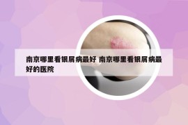 南京哪里看銀屑病最好 南京哪里看銀屑病最好的醫(yī)院