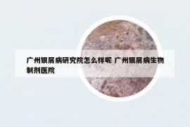 廣州銀屑病研究院怎么樣呢 廣州銀屑病生物制劑醫(yī)院