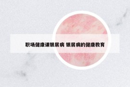 職場(chǎng)健康課銀屑病 銀屑病的健康教育