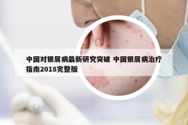 中國對(duì)銀屑病最新研究突破 中國銀屑病治療指南2018完整版
