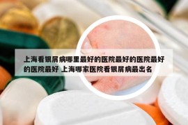 上海看銀屑病哪里最好的醫(yī)院最好的醫(yī)院最好的醫(yī)院最好 上海哪家醫(yī)院看銀屑病最出名