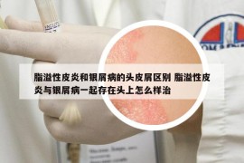 脂溢性皮炎和銀屑病的頭皮屑區(qū)別 脂溢性皮炎與銀屑病一起存在頭上怎么樣治