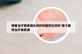 哪里治療銀屑病比較好的醫(yī)院比較好 哪個醫(yī)院治療銀屑病