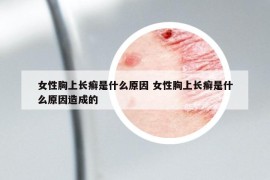 女性胸上長癬是什么原因 女性胸上長癬是什么原因造成的