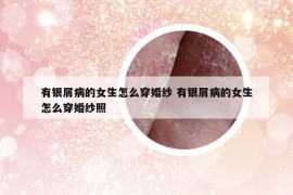 有銀屑病的女生怎么穿婚紗 有銀屑病的女生怎么穿婚紗照