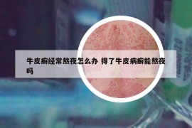 牛皮癬經(jīng)常熬夜怎么辦 得了牛皮病癬能熬夜嗎