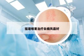 福建哪里治療白癜風最好