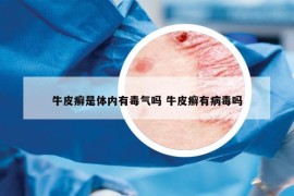 牛皮癬是體內(nèi)有毒氣嗎 牛皮癬有病毒嗎